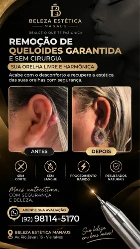 Remoção de queloides com laser