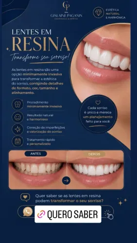 Lentes em resina | Transforme seu sorriso
