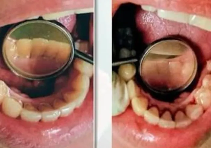 Limpeza dental