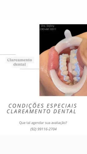 Clareamento dental 