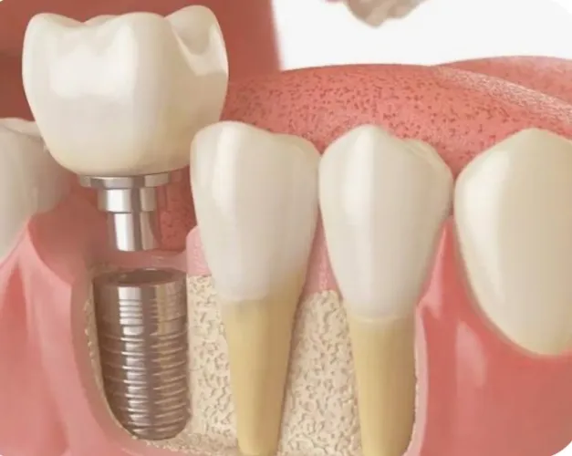 Implante dentário
