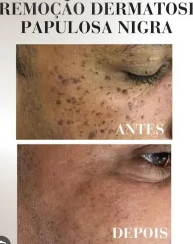 Retirada de sinais