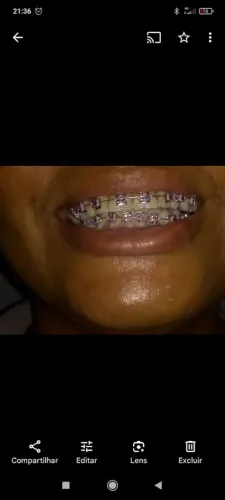 Aparelho estetico aparelho dente