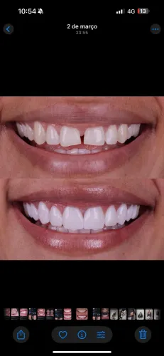 Facetas de resina 