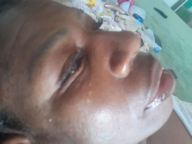 Remoção de sinais e pintas 