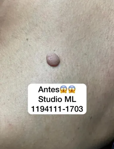 Remoção de verrugas na hora