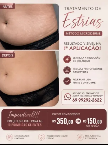 Tratamento zero estrias