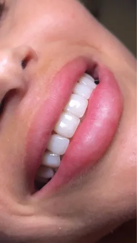 Facetas em Resina - Sessão unica e seu sorriso harmonico no mesmo dia