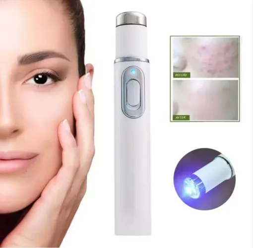 Caneta de Terapia com Luz Azul, para melhorar Acne, Cicatriz e Rugas. 