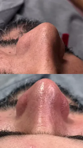 Limpeza de pele 