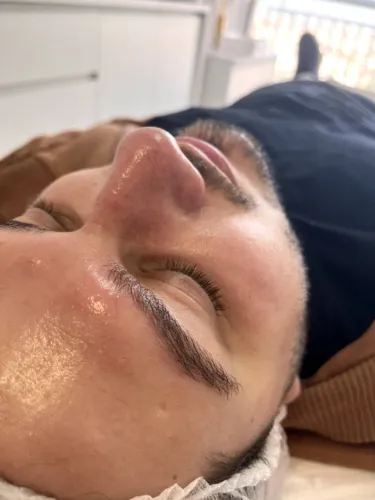 Limpeza de Pele Profissional |Peeling | Microagulhamento| Atendimento em Guarulhos