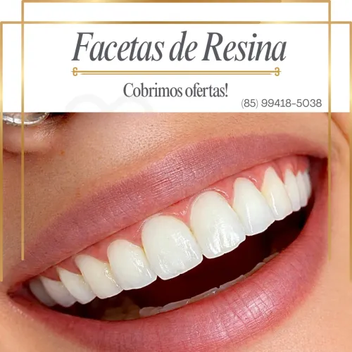 Facetas de resina composta
