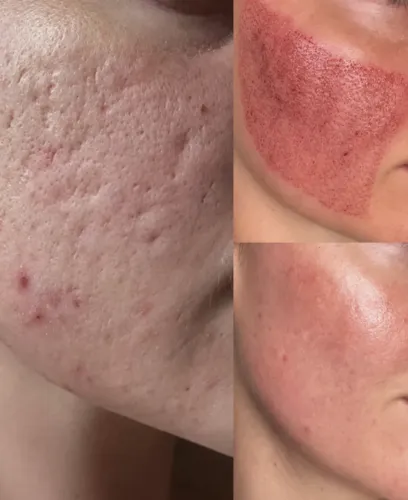 Modelo para cicatrizes de acne ? R$ 150 por sessão
