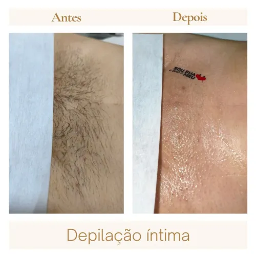 Depilação 