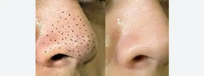 Limpeza de pele com extração 