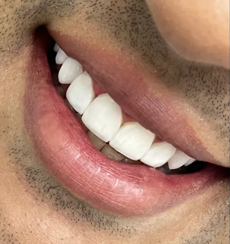 ? FACETAS EM RESINA COMPOSTA ? PACIENTE MODELO