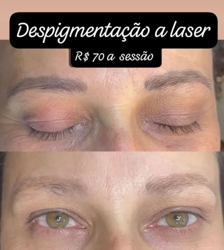 Remoção a laser