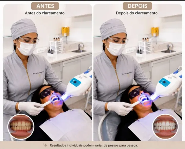 Clareamento dental em promoção 