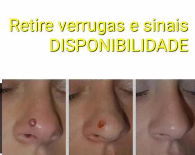 RETIRE VERRUGAS E SINAIS 