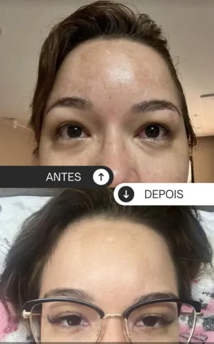 Creme Nova Pele para melasma, rugas, marcas de expressão.