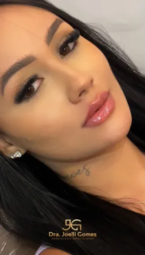 Preenchimento labial 