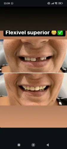 PRÓTESE DENTADURA CHAPA 