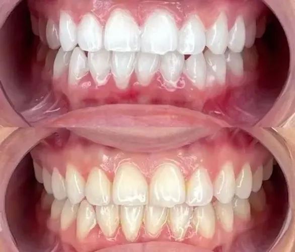 Dentes brancos