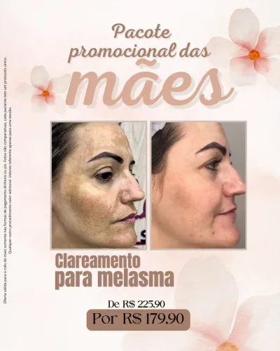 Clareamento para melasma
