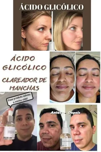 Acido Glicólico Clareador de Manchas e Melasmas Pele Saudável e Uniforme