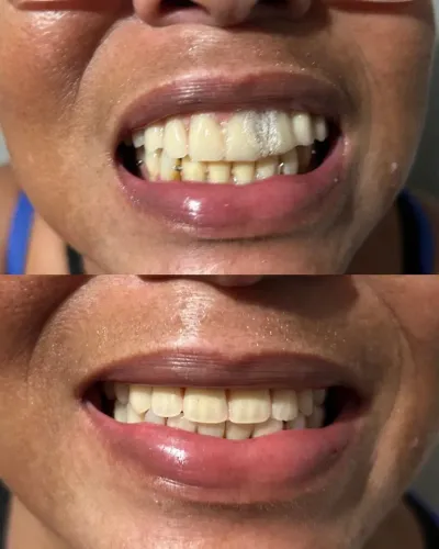 Protése dentária com preço acessível 