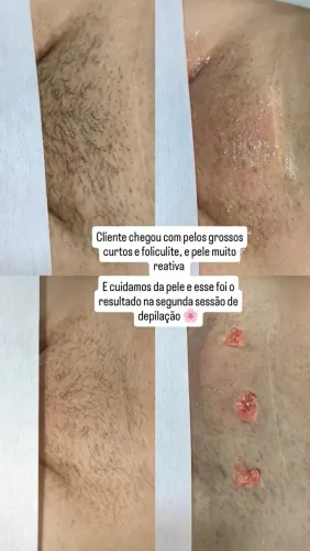 Depilação personalizada 