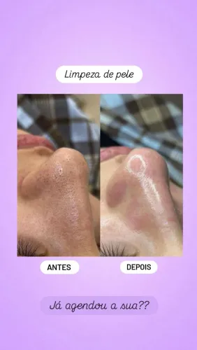 Limpeza de pele profunda
