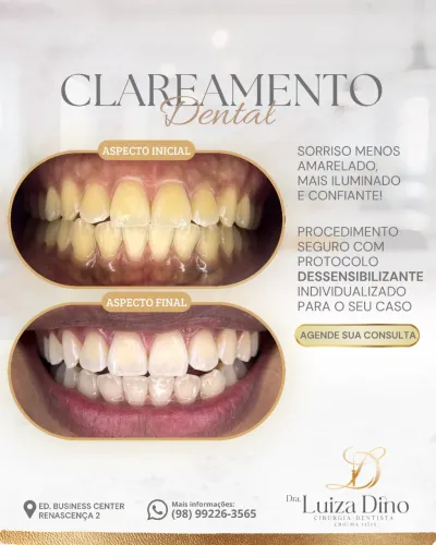 Clareamento Dental em consultório 