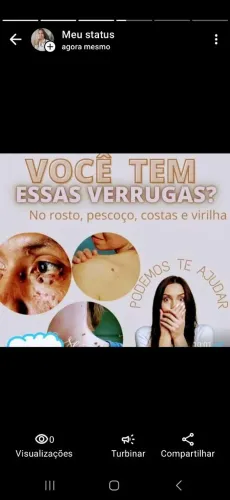 Remoção de sinal e verrugas chama *06