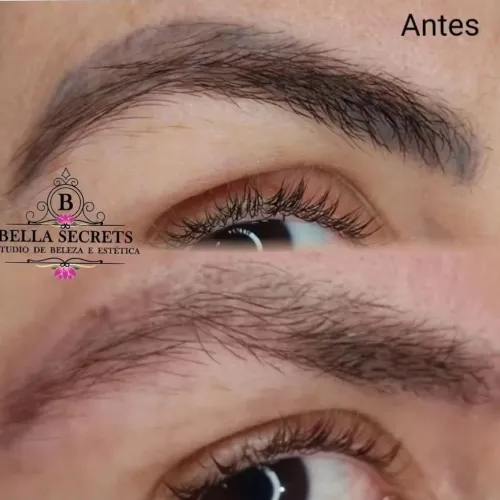 Despigmentação remoção de sobrancelha a laser 