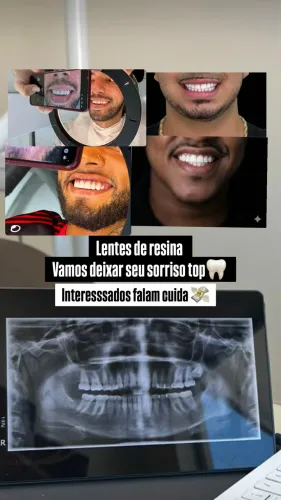 Lentes de resina