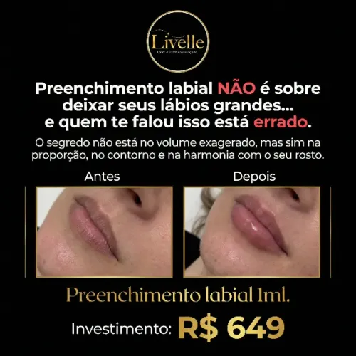 Tratamento com Preenchimento labial - seus lábios renovados e com harmnia.
