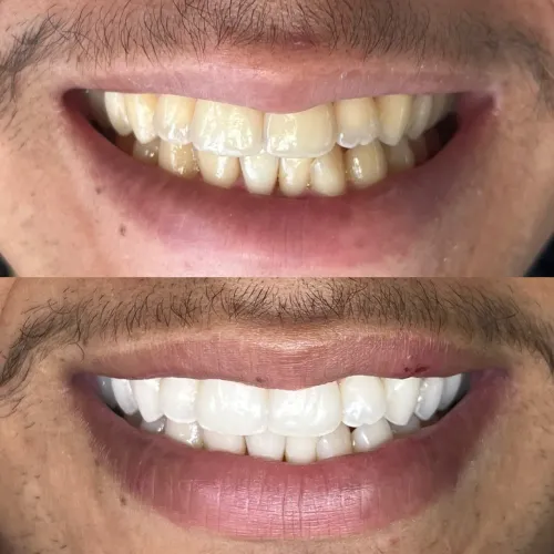 Clareamento dental 