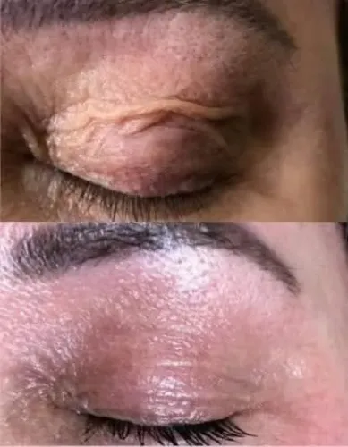 Blefaroplastia Modelos