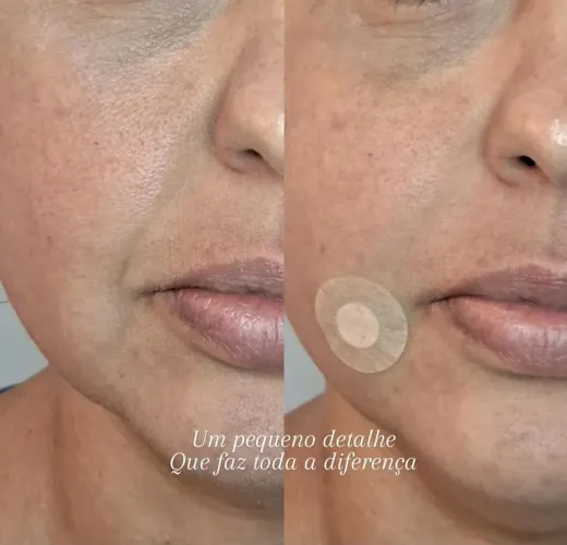 Preenchimentos Faciais, corporais e íntimo