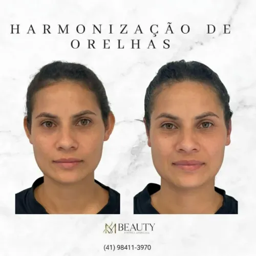 Harmonização de orelhas