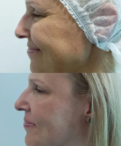 Botox 600