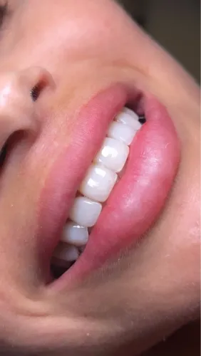 Facetas em Resina Estratificadas