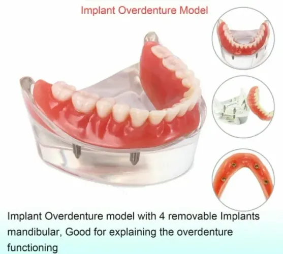 Manequim Modelo Protocolo sobre Implantes Overdenture Inferior