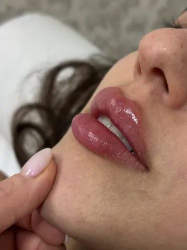 PREENCHIMENTO LABIAL