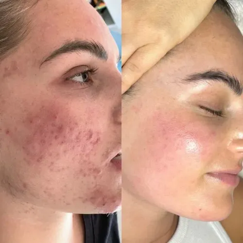 Microagulhamento para rejuvenescimento/ clarear pele / cicatrizes de acne est colágeno