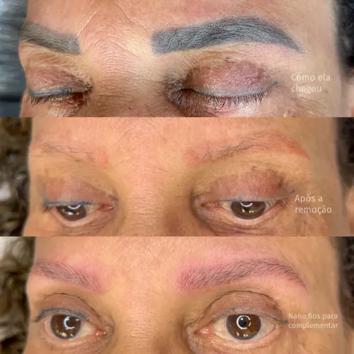 Remoção, despigmentação à Laser.