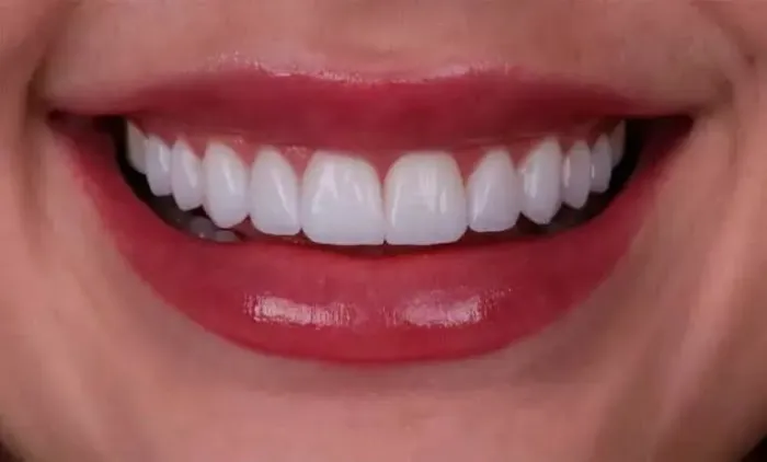 Facetas em resina promoção 