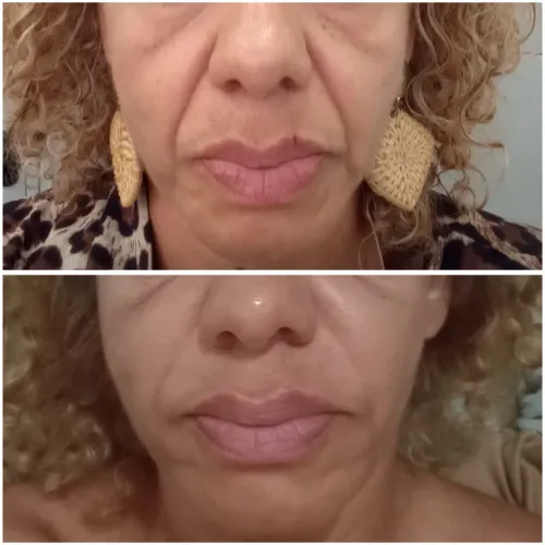 Rejuvenescimento facial