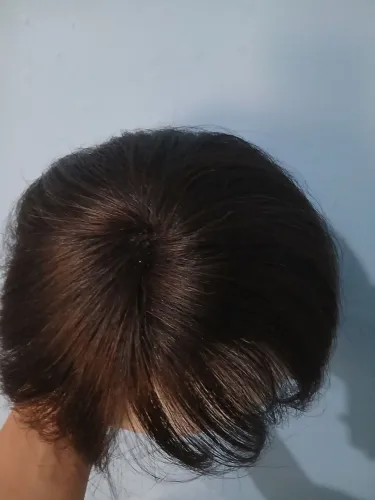 Prótese capilar em micropele fio a fio